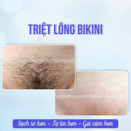 Triệt lông vùng kín: An toàn, kín đáo và hiệu quả
